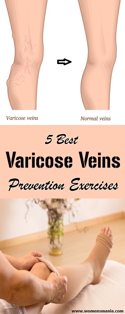 best exercises for varicose veins treatment