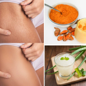 10 Simple & Best Home Remedies For Stretch Marks
