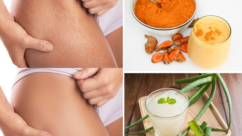 10 Simple & Best Home Remedies For Stretch Marks