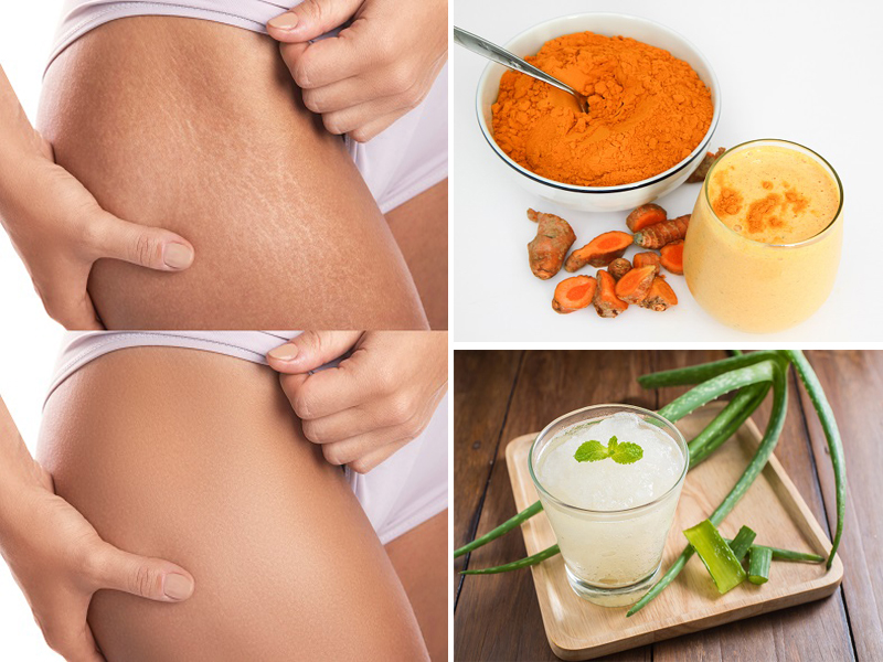 home remedies for stretch marks