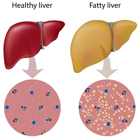 healthy liver vs fatty liver