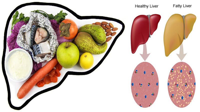 10 Best Tips To Prevent Fatty Liver: Diet and Lifestyle Tips