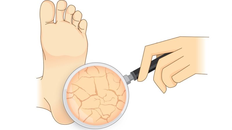 10 Simple and Best Home Remedies For Cracked Heels