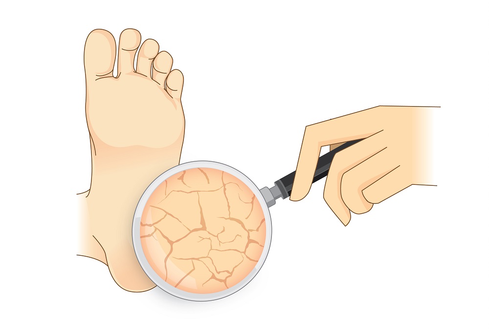 10 Simple and Best Home Remedies For Cracked Heels